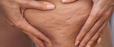 Aplicación de carboxiterapia para reducir celulitis y flacidez