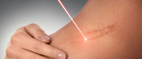 Eliminación de cicatrices con tratamiento estético