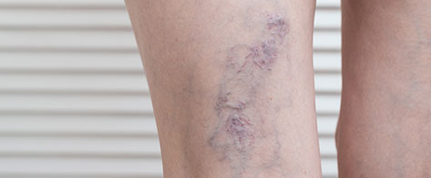 Tratamiento para eliminar varices