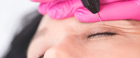 Tratamiento de blefaroplastia sin cirugía con láser Plexr