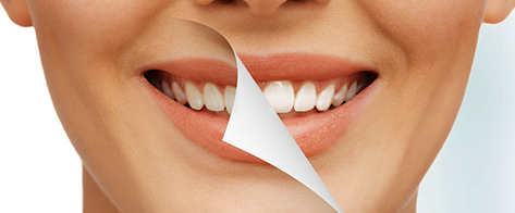 Resultado de un tratamiento de blanqueamiento dental