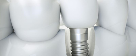 Ejemplo de implantes dentales colocados