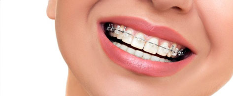 Corrección dental mediante ortodoncia