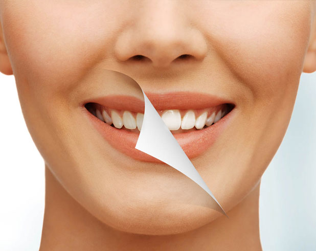 Resultado de un tratamiento de blanqueamiento dental