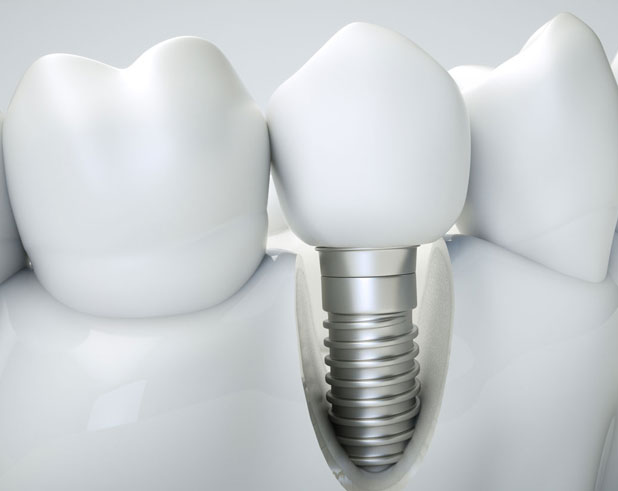 Ejemplo de implantes dentales colocados