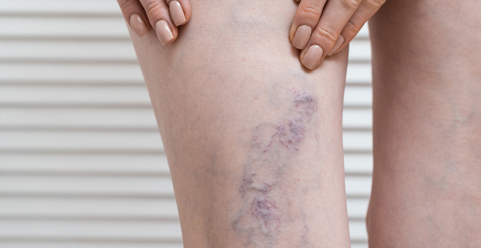 Tratamiento para eliminar varices