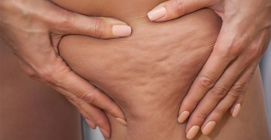 ¿Cómo acabar con la celulitis antes del verano?