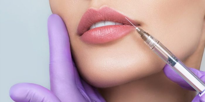 Russian Lips: la tendencia más buscada en relleno de labios